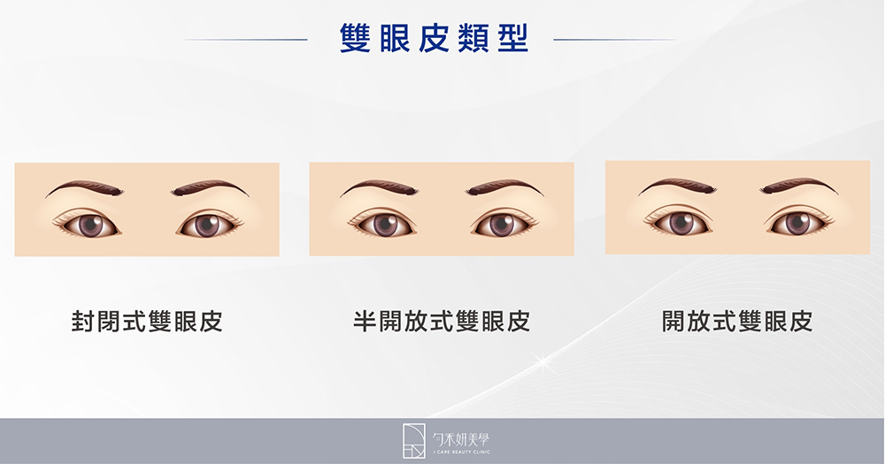 雙眼皮類型：封閉式雙眼皮/半開放式雙眼皮/開放式雙眼皮