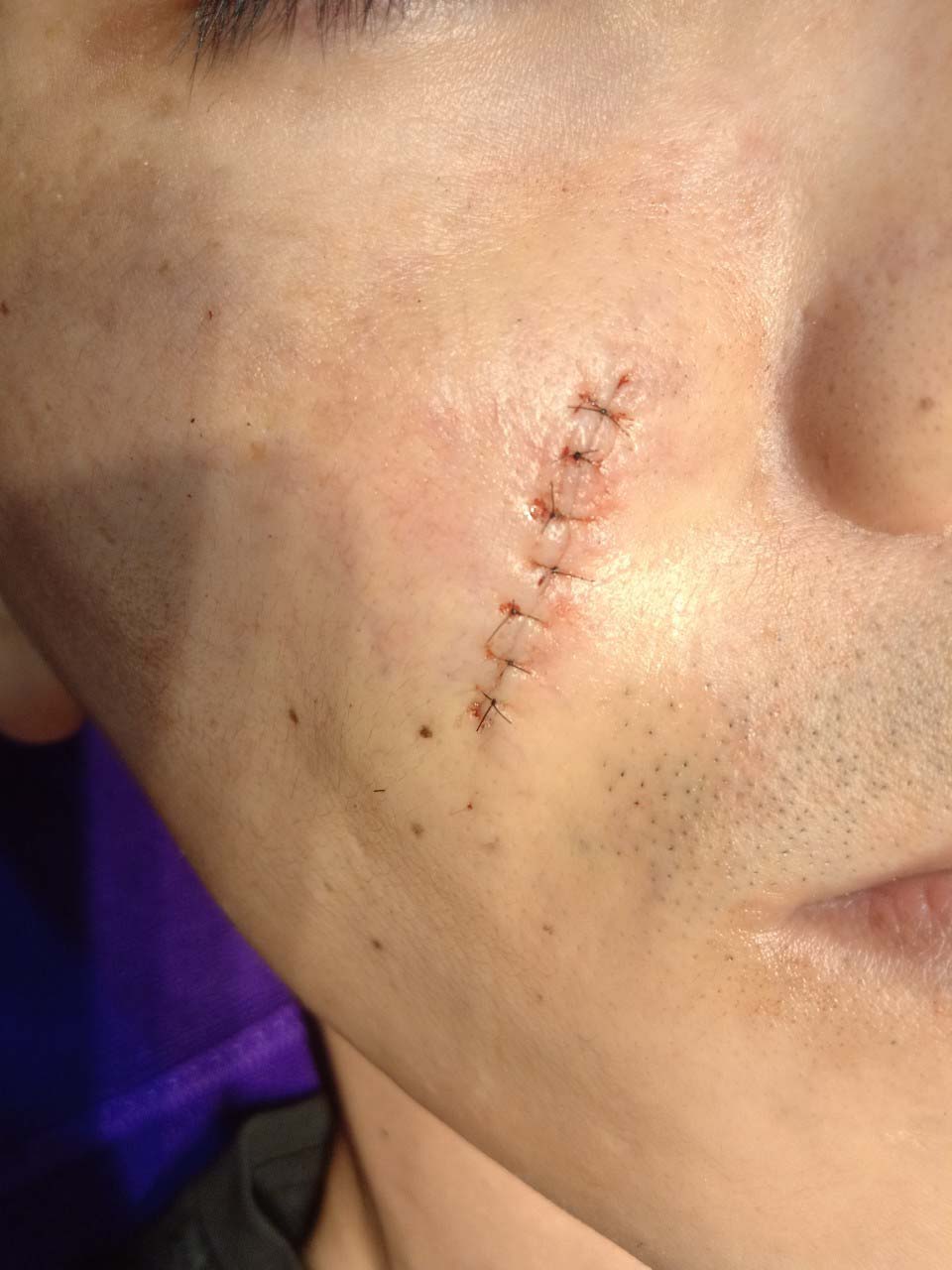 傷口疤痕重新修補 - 皮膚微創手術前