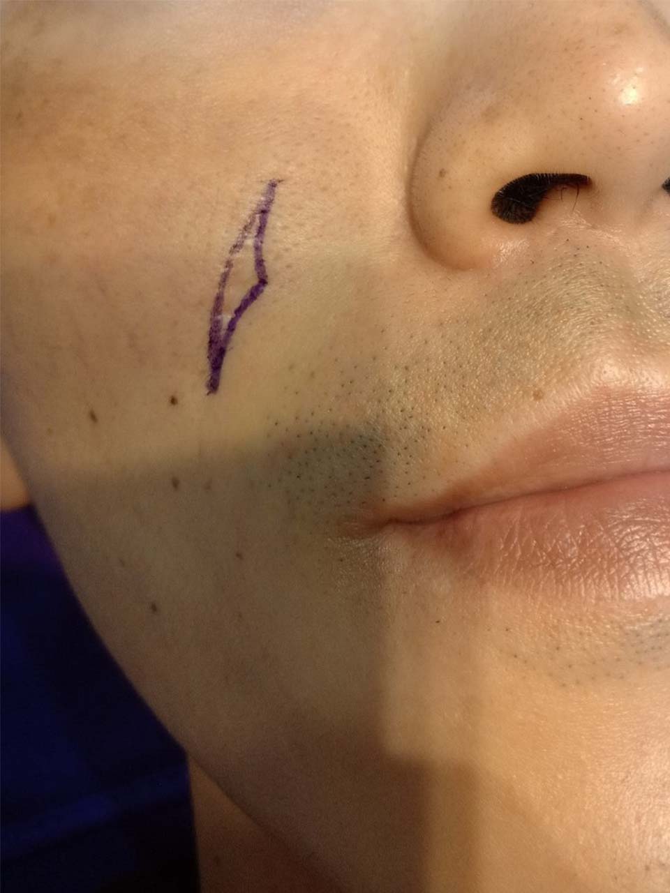 傷口疤痕重新修補 - 皮膚微創手術後